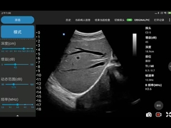 Thiết bị siêu âm không dây mảng lồi điện tử cho điện thoại di động