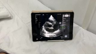 Đầu dò siêu âm không dây hai đầu cho tim và POCUS