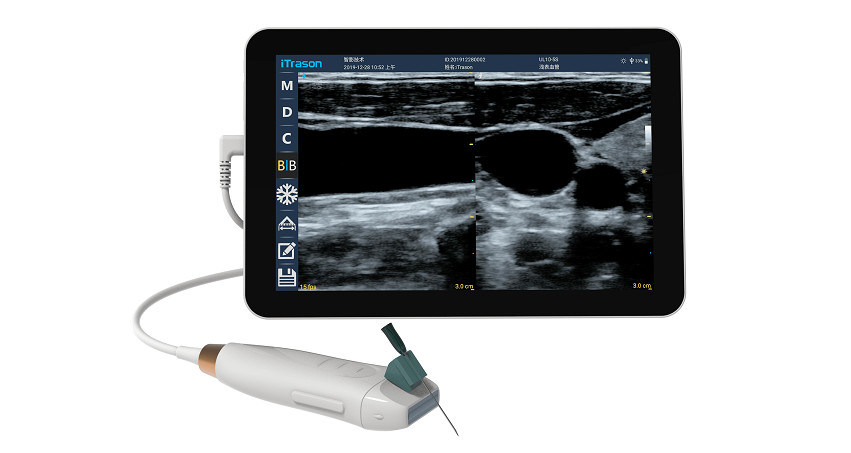 Máy quét siêu âm cầm tay với đầu dò tuyến tính tần số cao 12MHZ để truy cập mạch máu chính xác và thủ tục chèn PICC